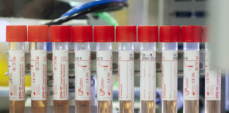 Coronavirus, in Lombardia effettuati oltre 70.000 tamponi.