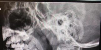 Stella di metallo nella trachea, bimbo di 8 anni salvato al Niguarda