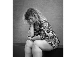 Primo intervento per Cocca, la ragazza che soffre di lipedema.