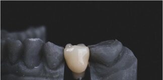 Salute della bocca: cosa significa devitalizzare un dente