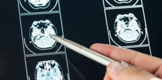 Intelligenza Artificiale per prevedere lo sviluppo del Parkinson