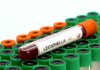 Focolaio legionella, Ats al lavoro